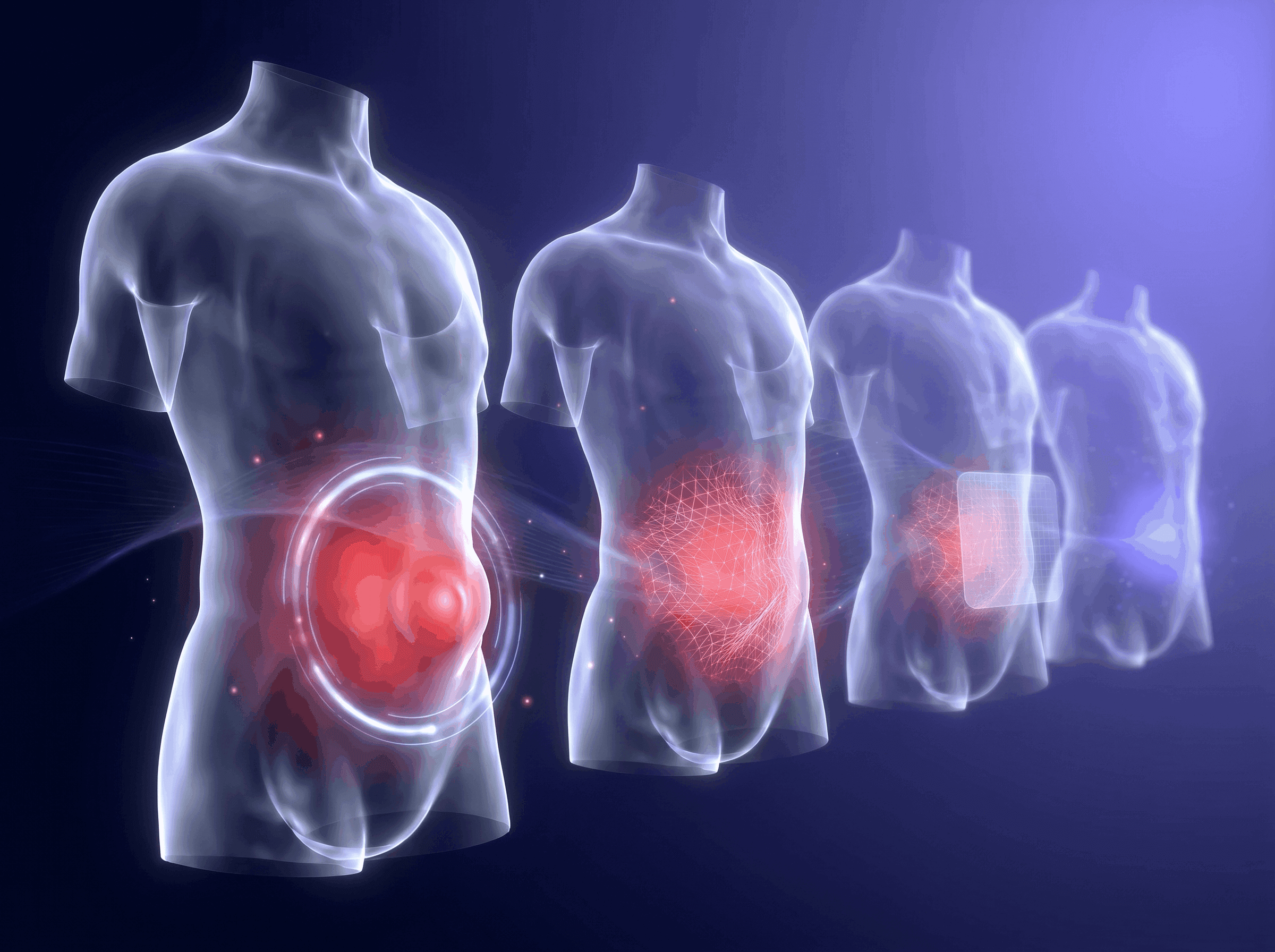 Laparoscopic Hernia Repair Without Open Surgery — Best Surgeon